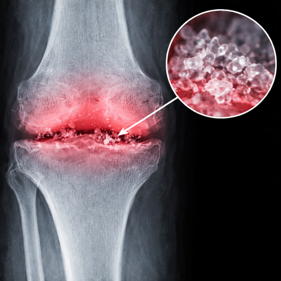 Calcium crystals grinding inside joints